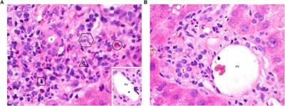 The Immunological Basis of Liver Allograft Rejection